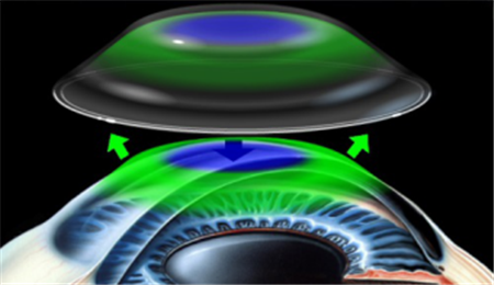 小兒眼病,希瑪瑞視眼科,上海眼科醫(yī)院