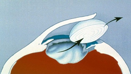 白內(nèi)障,?，斎鹨曆劭?上海眼科醫(yī)院