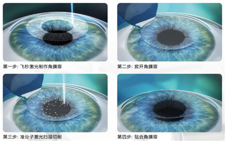 屈光矯視,?，斎鹨曆劭?上海眼科醫(yī)院