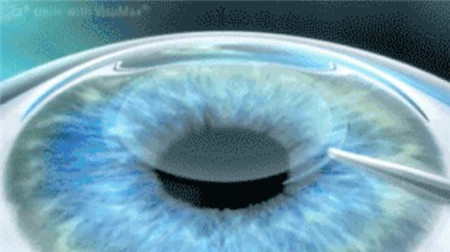 屈光矯視,?，斎鹨曆劭?上海眼科醫(yī)院