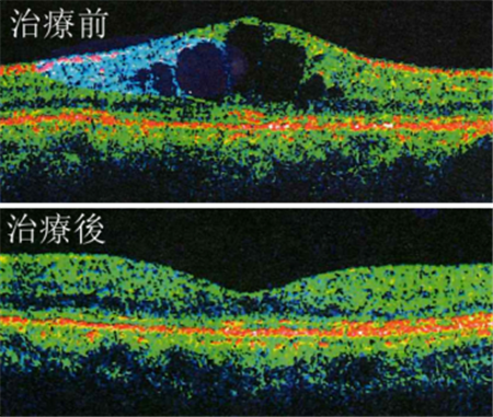 玻璃體視網(wǎng)膜,?，斎鹨曆劭?上海眼科醫(yī)院
