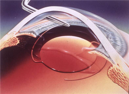 白內(nèi)障,?，斎鹨曆劭?上海眼科醫(yī)院