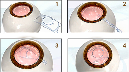 屈光矯視,?，斎鹨曆劭?上海眼科醫(yī)院