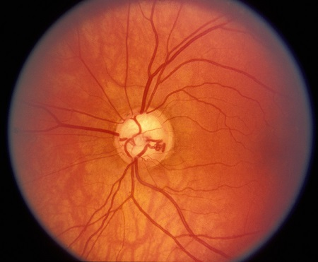 青光眼,?，斎鹨曆劭?上海眼科醫(yī)院