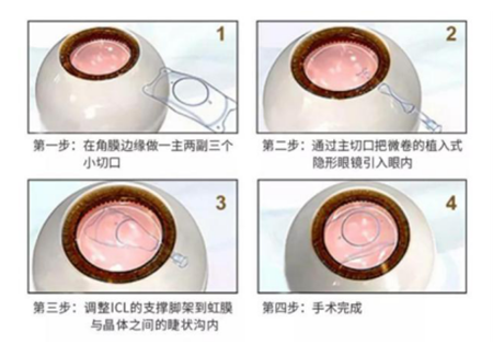 屈光矯視,?，斎鹨曆劭?上海眼科醫(yī)院