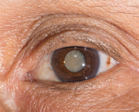 白內(nèi)障,希瑪瑞視眼科,上海眼科醫(yī)院