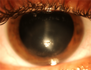 眼表眼角膜,希瑪瑞視眼科,上海眼科醫(yī)院