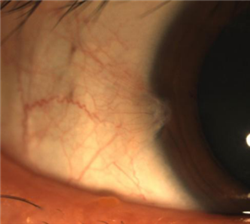 眼表眼角膜,?，斎鹨曆劭?上海眼科醫(yī)院