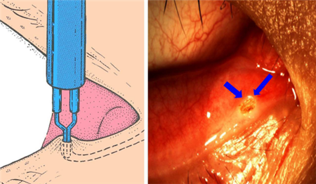 眼表眼角膜,?，斎鹨曆劭?上海眼科醫(yī)院