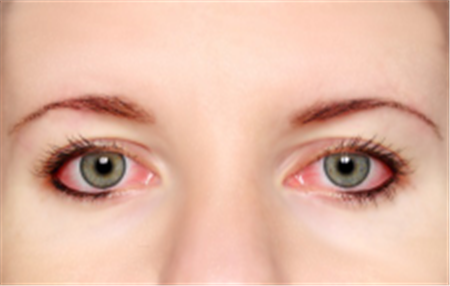 眼表眼角膜,?，斎鹨曆劭?上海眼科醫(yī)院