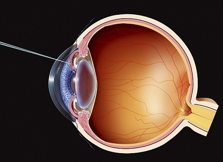 眼表眼角膜,?，斎鹨曆劭?上海眼科醫(yī)院