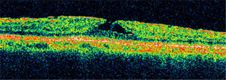 玻璃體視網(wǎng)膜,?，斎鹨曆劭?上海眼科醫(yī)院
