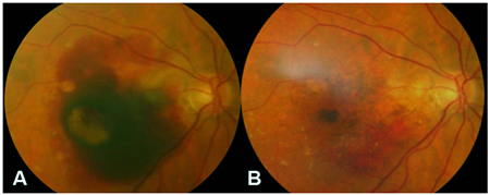 玻璃體視網膜,?，斎鹨曆劭?上海眼科醫(yī)院