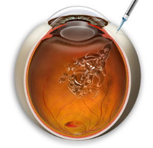 玻璃體視網(wǎng)膜,?，斎鹨曆劭?上海眼科醫(yī)院