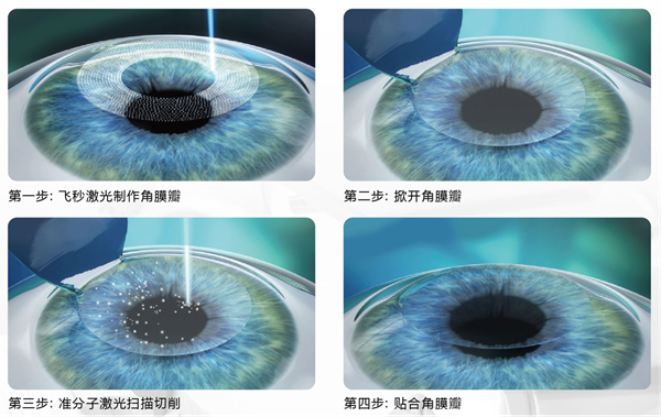 屈光矯視,希瑪瑞視眼科,上海眼科醫(yī)院