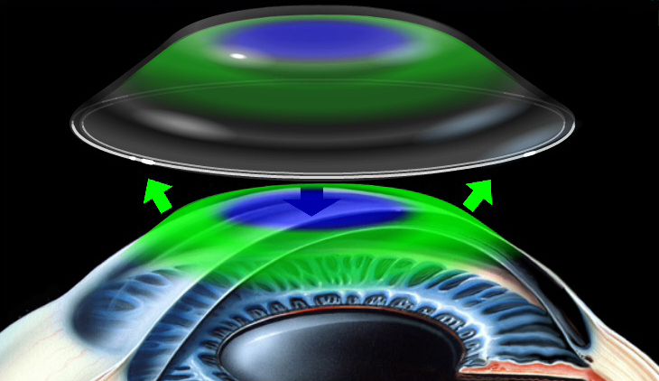 屈光矯視,希瑪瑞視眼科,上海眼科醫(yī)院