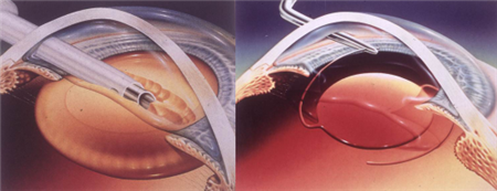 白內(nèi)障,?，斎鹨曆劭?上海眼科醫(yī)院